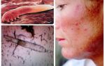 Piolhos subcutâneos em humanos no corpo e cabeça