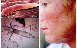 Piolhos subcutâneos em humanos no corpo e cabeça
