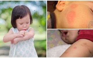 Picadas de mosquito na pele de um adulto ou criança