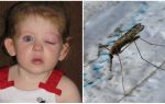 O que fazer se uma criança tiver um olho inchado depois de uma picada de mosquito