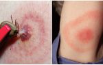 O que é a doença de Lyme, seus sintomas, tratamento e foto