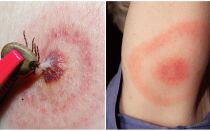 O que é a doença de Lyme, seus sintomas, tratamento e foto