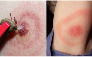 O que é a doença de Lyme, seus sintomas, tratamento e foto