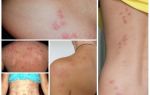O que são insetos perigosos e suas mordidas?