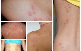 O que são insetos perigosos e suas mordidas?