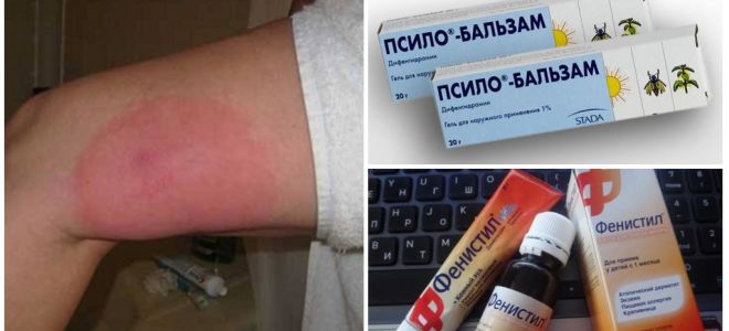 O que fazer se depois de uma perna de picada de mosquito inchada