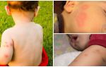 Fundos para crianças após picadas de mosquito