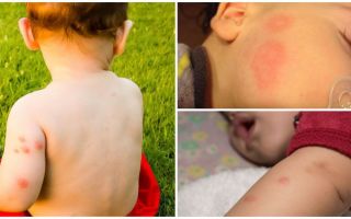 Fundos para crianças após picadas de mosquito
