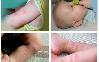 O que fazer se uma criança for mordida por uma pulga?