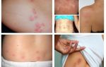Como são as picadas de percevejos na pele humana?