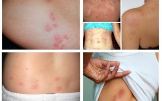 Como são as picadas de percevejos na pele humana?