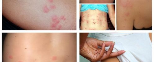Como são as picadas de percevejos na pele humana?