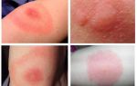 Mordidas de mosquitos em foto e tratamento de uma pessoa