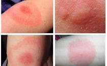 Mordidas de mosquitos em foto e tratamento de uma pessoa