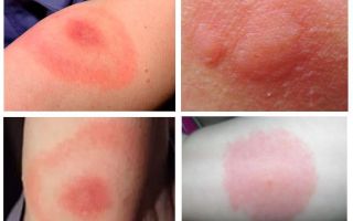 Mordidas de mosquitos em foto e tratamento de uma pessoa