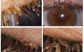 Piolhos e lêndeas ciliados