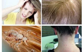 Por que coça a cabeça depois de remover os piolhos