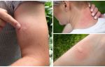 Como remover o inchaço e coceira de picadas de mosquito em uma criança e um adulto