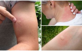 Como remover o inchaço e coceira de picadas de mosquito em uma criança e um adulto