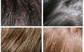 Piolhos no cabelo das crianças