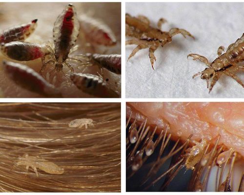 Como remover rapidamente piolhos e lêndeas em casa