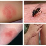 Mordidas Midge