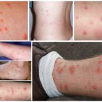 Mordidas de pulgas no corpo