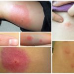 Mordidas de barata