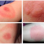 Alergia à picada de melro