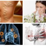 Alergia, doença cardíaca, tuberculose