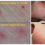 Mordidas Midge