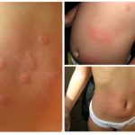 Alergia a picadas de pulgas