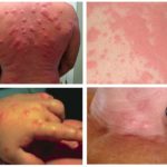 Alergia a picadas de percevejos