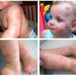 Alergia a picadas de insetos em crianças