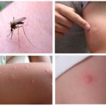 Picadas de mosquito