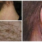Tipos de Pediculose