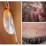Perigo de pediculose