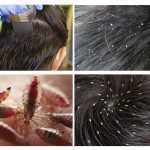 Pediculose Diferença