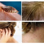 Sintomas de pediculose