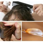 Controle de pediculose