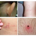 O aparecimento de várias picadas de pragas