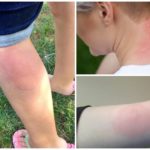 Alergia à picada de mosquito