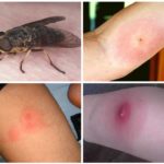Mordida de Gadfly