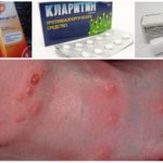 Alergia à picada
