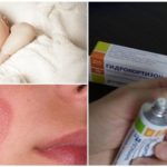 Contra-indicações para o uso de pomada de hidrocortisona
