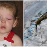 Olhos inchados de uma criança de uma picada de mosquito