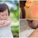 Picadas de mosquito em crianças
