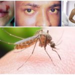 Possíveis efeitos de uma picada de mosquito