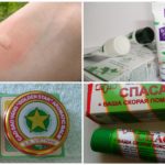 Tratamento de mordida de mosquito