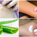 Receitas tradicionais para o tratamento de picadas de mosquito
